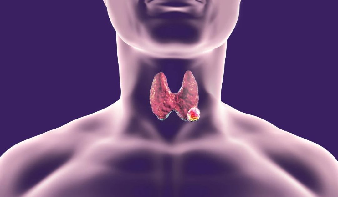 Thyroid Cancer – Symptoms, Treatment & Support